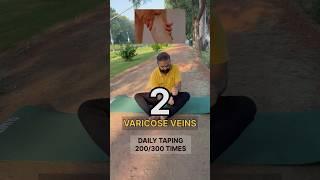 Varicose vein & numbness #shorts #yoga #taping #accupressure #legs #legspain #numbness #varicosevein