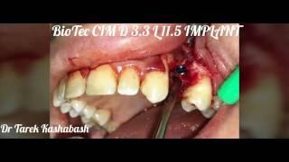 Biotec implant GmbH - CIM implant