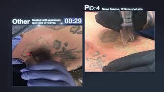 PiQo4 Tattoo Removal