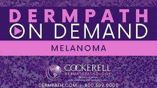 Melanoma