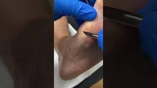 Bunion Callus Removal by cutting in the podiatry clinic