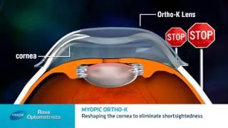 Short sighted Ortho-keratology - Can short sighted people have orthokeratology? - Rose Optometrists