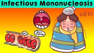 Infectious Mononucleosis (IMN/Glandular Fever) - Causes, Signs & Symptoms, Diagnosis & Treatment