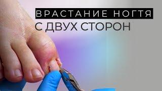 Врастание ногтя с двух сторон. Провожу резекцию (иссечение врастающего сегмента)