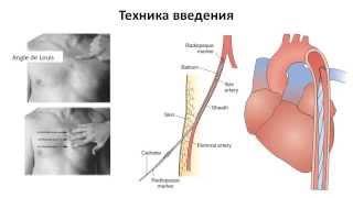 ВнутриАортальня Баллонная Контрпульсация     Савченко Я.В.