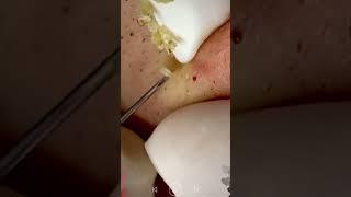 Skincare | Blackheads Removal #482 #tweezers skincare #blackheads blackheads