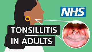 Tonsillitis in adults: Symptoms and treatment | NHS