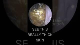 HARD EAR WAX & SKIN PLUG REMOVAL