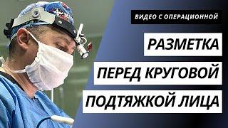 РАЗМЕТКА ПЕРЕД КРУГОВОЙ ПОДТЯЖКОЙ ЛИЦА | КОМПЛЕКСНОЕ ОМОЛОЖЕНИЕ ЛИЦА | ПОДТЯЖКА ЛИЦА КИЕВ