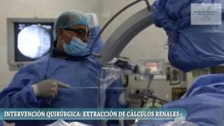 Dr Miguel Suarez - Extracción de cálculos renales