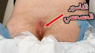 ماهو الناسور العصعصي؟ وكيف يتم علاجة_?What is the pilonidal sinus