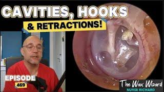 CAVITIES, HOOKS & RETRACTIONS! Episode 469