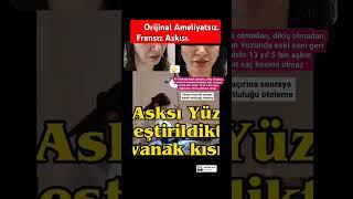 Ameliyatsız yüz germe,  Fransız Askısı Deep Lift, Fransız Askısı nasıl yapılır.