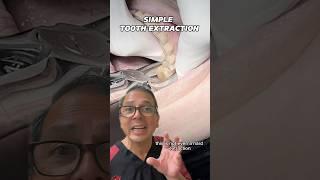 Simple Tooth Extraction on Upper Molar | In Office to Hands On Dental Training #shorts