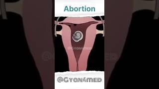 Abortion Animation