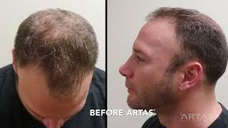 The Best FUE procedure, ARTAS Robotic FUE