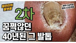 (ENG/JPN) 40년 된 그 발톱 도대체 얼마나 펴졌을까요? 두번째 관리  (ingrown toenail / 레푸스삼덕점, 레푸스진천역점/ 대구레푸스)