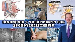 The BEST Video on Spondylolisthesis! How to Diagnose & the Many Treatments (Spine Surgeon)