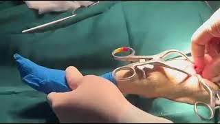 Removing the Femoral head