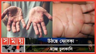 শিশুদের মধ্যে দেখা দিয়েছে হ্যান্ড-ফুট-মাউথ রোগের প্রকোপ  | Hand Foot and Mouth Disease | Somoy TV