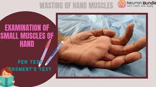 Examination of hand muscles & Wasting of hand muscles #motorneurondisease #Froment’sSign