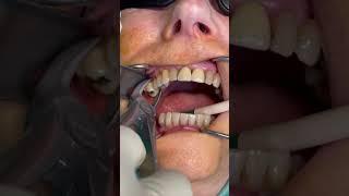 Beautiful tooth extraction | painless dentistry #shorts #health #beauty