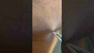 Sit Back and Relax: Watch Beard Hair Get Tweezed #satisfying #tweezers #plucking