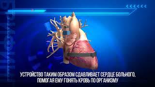 Механическое сердце упростит жизнь