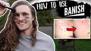 HOW TO GET RID OF ACNE SCARS AT HOME (BANISH)