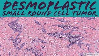 Desmoplastic Small Round Cell Tumor: 5-Minute Pathology Pearls