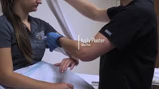 Coaptation Splint - Proliance Orthopaedics & Sports Medicine