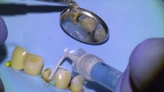 [34] Live Root Canal Retreatment Procedure