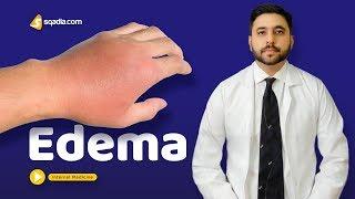 Edema | Medicine Video Lectures | Medical Student Education | V-Learning | sqadia.com