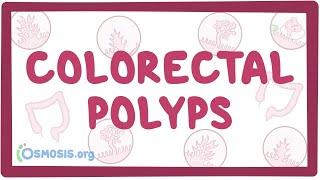 Colorectal polyps - an Osmosis Preview