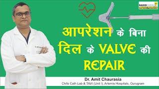 What is MitraClip Valve Procedure, Risk & Success Rate | Dr Amit Chaurasia