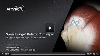 SpeedBridge™ Rotator Cuff Repair Using the SpeedBridge™ Implant System