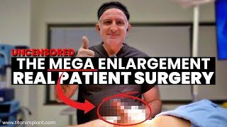 (UNCENSORED) AGAIN! 2.5 to 6.5 Inches - XL Himplant by Penuma Surgery - Mega Penis Enlargement