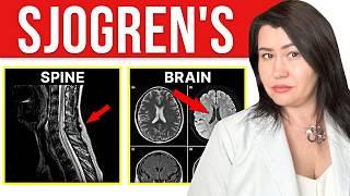 How SJOGREN'S Syndrome Affects Your BRAIN & Spine: Rheumatologist Explains