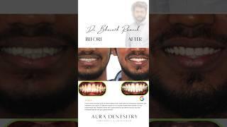  From Protruded Teeth to Perfect Smile | Braces Specialist in Chromepet & Urapakkam
