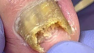 Extremely curly and growing nails, infected by onychomycosis bacteria【Doctor Liu Pedicure】
