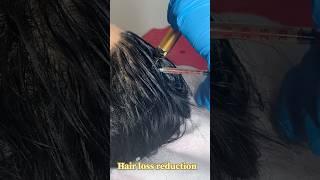 Hair regrowth Gfc Treatment Skin smile clinic Bhopal #skincare #bhopal #gfc #hairgrowth