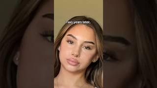 Moon face is REAL