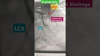 100% blockage Angiography l #echo #heartattack #shorts