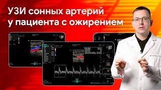 УЗИ сонных артерий у пациента с ожирением на Mindray Resona i9