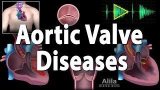 Aortic Valve Disease, Animation