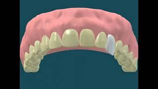 Dental Video for Veneers for Stained Teeth - The Tooth