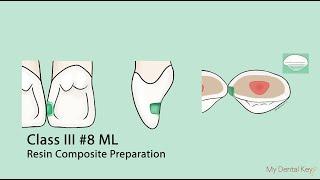 Class III Resin Composite Preparation | My Dental Key