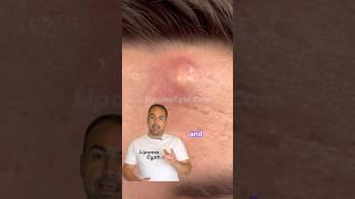 Dr Khaled Sadek explains infected cysts .LipomaCyst.com