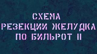 Схема резекции желудка по Бильрот II