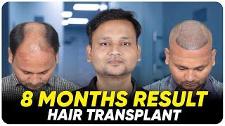 Hair Transplant in India | Best Results & Cost of Hair Transplant in India